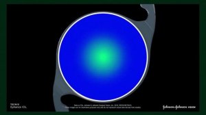 Tecnis Eyhance - монофокальная иол со средней дистанцией. Обзор хрусталика от врача-офтальмолога