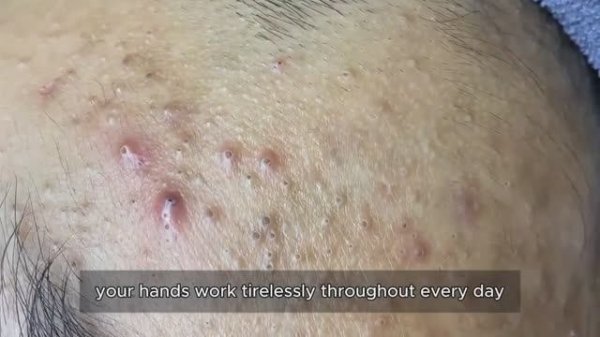 Механическая чистка лица от комедонов #𝟗𝟎532