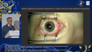 Секция 5 «Лечение пациентов с несодружеств. формами косоглазия: стратегия, тактика, методы» Часть 2