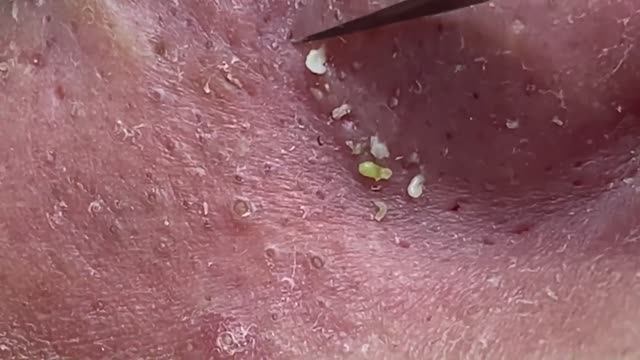 Asmr. Очищение кожи от черных точек. #119 #угреваясыпь #удалениепрыщей смотреть онлайн