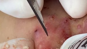 Выдавливание прыщей, угрей, черных точек и камедонов #34