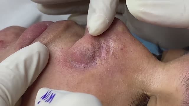 Глубокая чистка кожи от комедонов: результаты. #118 смотреть онлайн