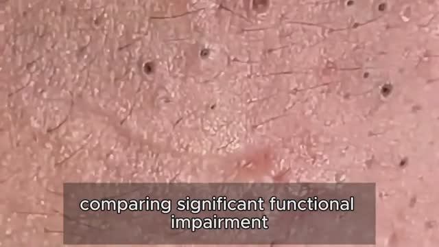 Глубокое очищение кожи от прыщей без скрабирования. #𝟗𝟎528 смотреть онлайн