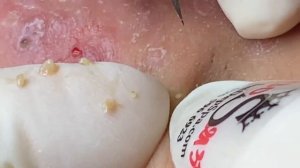 Выдавливание прыщей, угрей, черных точек и камедонов #33