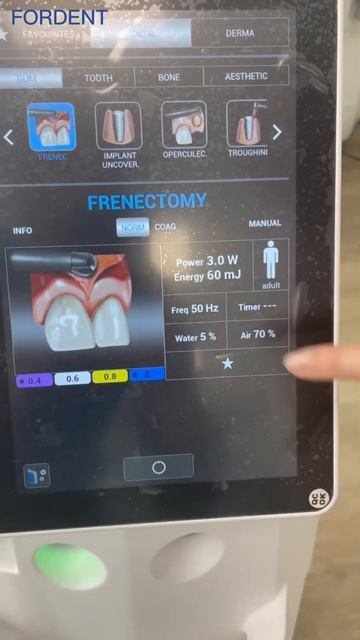 Обзор стоматологического эрбиевого Лазера Doctor Smile Pluser