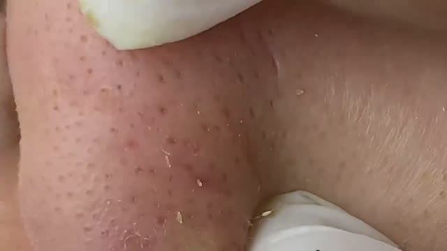 Удаление больших черных точек в носу смотреть онлайн