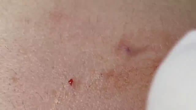 Очистка от черных точек возле губ смотреть онлайн