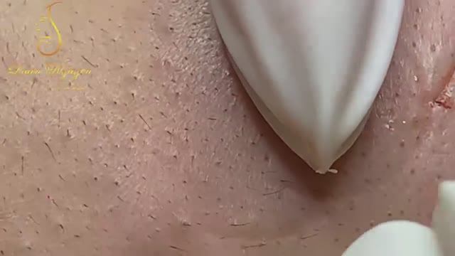 Выдавливание гигантских черных точек и тяжелых кистозных прыщей смотреть онлайн