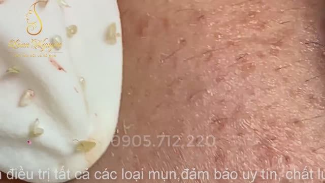 БЕЛЫЕ УГРИ как спагетти: супер-удлиненные комедоны. смотреть онлайн