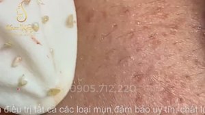 БЕЛЫЕ УГРИ как спагетти: супер-удлиненные комедоны.