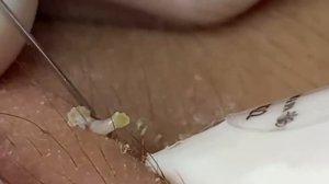 Выдавливание прыщей, угрей, черных точек и камедонов #36