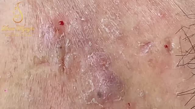 УДАЛЕНИЕ ГИГАНТСКИХ черных точек у косметолога смотреть онлайн