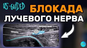 БЛОКАДА ЛУЧЕВОГО НЕРВА в нижней трети плеча. Медиальный доступ
#painmanagment #узинавигация