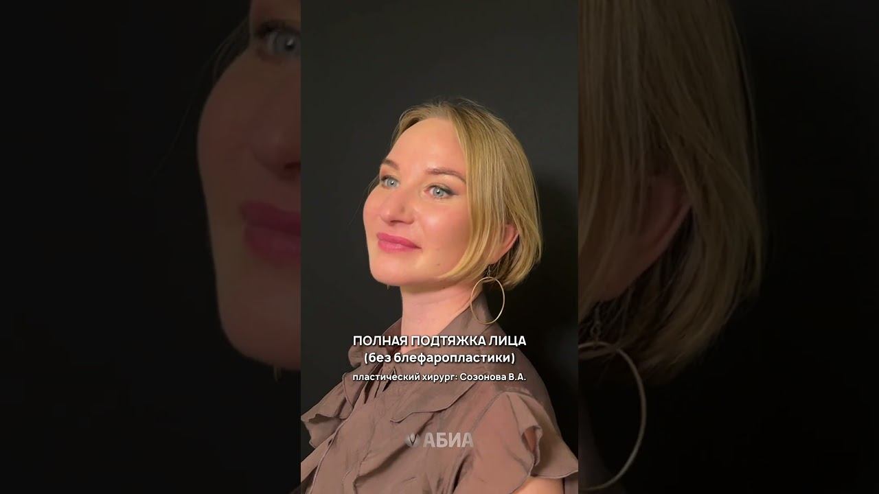 Полная подтяжка лица молодой пациентке. Сколько лет ей, как думаете? #пластическийхирург