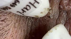 Выдавливание прыщей, угрей, черных точек и камедонов #39