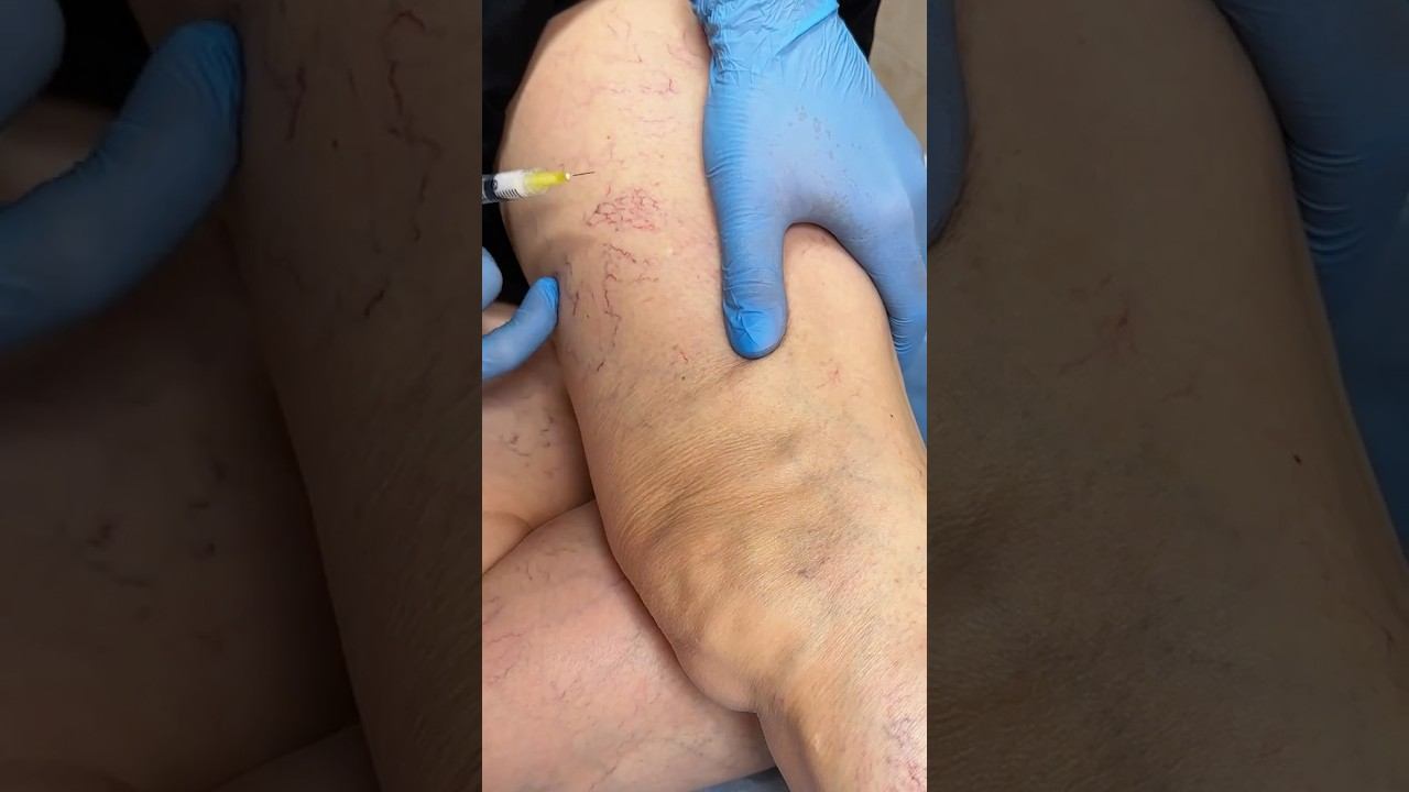 Склеротерапия: как убрать вены. Врач-флеболог, сосудистый хирург клиники «АБИА» - Жердев Н.Н.