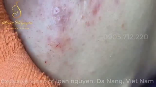 Удаление черных точек и прыщей: мастер-класс с результатом! смотреть онлайн