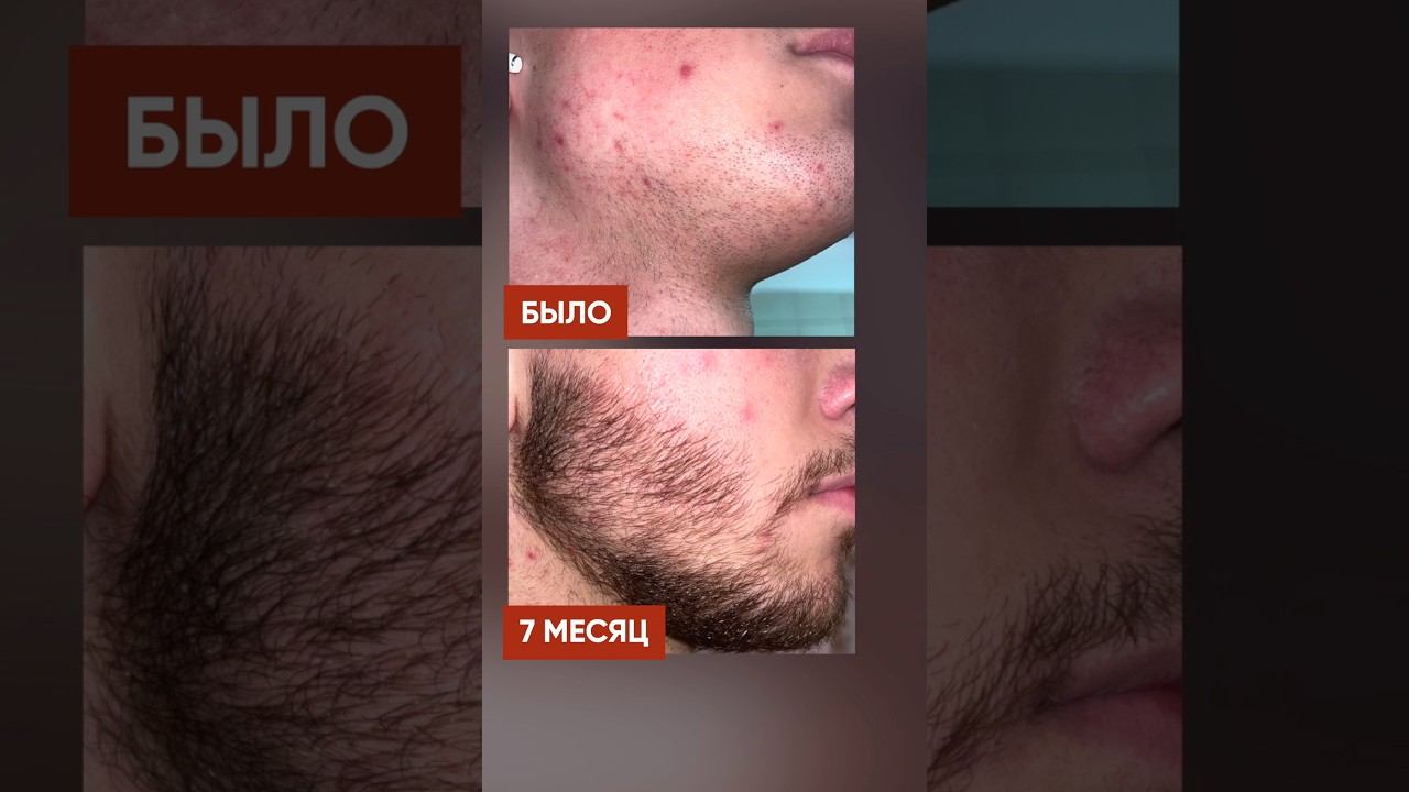 Запустил рост бороды с помощью лосьона