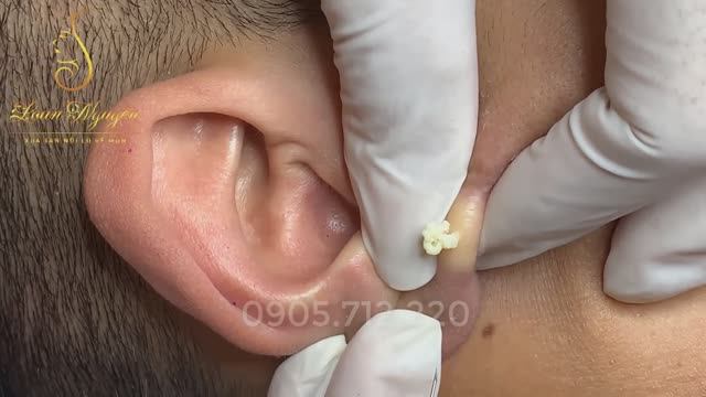 Удаление капсулы (мешочка) кисты уха смотреть онлайн