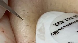 Выдавливание прыщей, угрей, черных точек и камедонов #42