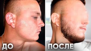 Мазал это средство и ОТРАСТИЛ БОРОДУ С НУЛЯ. Результат XILNOXIN