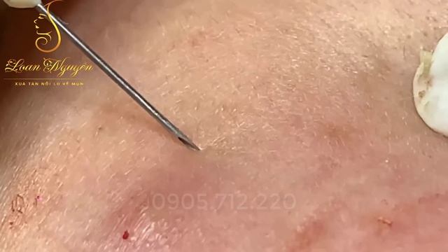 УДАЛЕНИЕ прыщей: ПРАВДА, которая БОЛИТ? смотреть онлайн