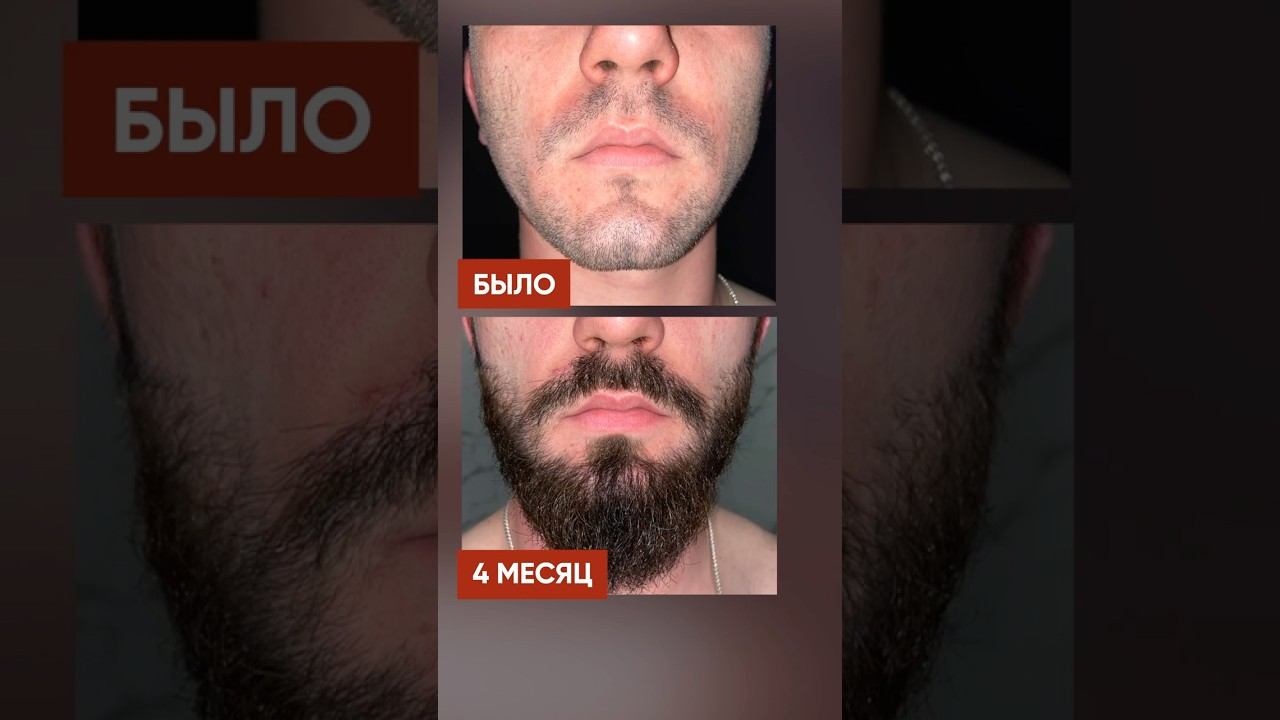 Олимпийская борода с помощью лосьона для роста