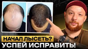 Как победить облысение. Рабочие способы, но нужно делать быстро!