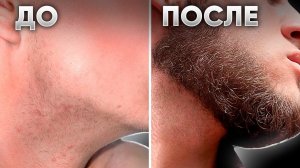 С НУЛЯ отрастил НЕРЕАЛЬНУЮ БОРОДУ. Результат применения XILNOXIN
