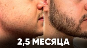 Отрастил НЕРЕАЛЬНУЮ бороду с нуля за 2,5 месяца. Результаты XINOXIN