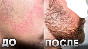 Отрастил бороду с помощью средства! Результаты XILNOXIN за 3 месяца