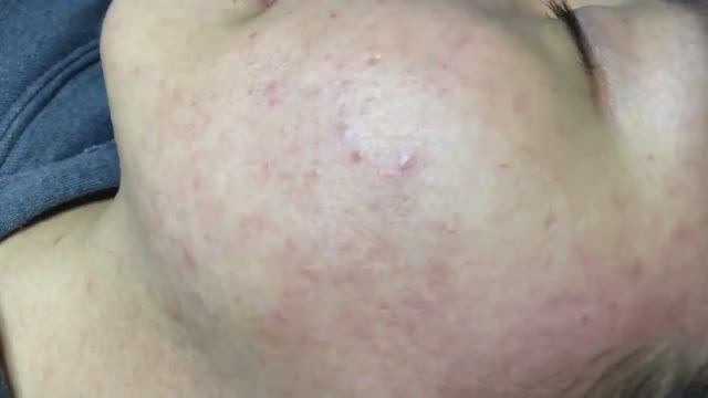 Лечение подкожных прыщей (скрытых акне) смотреть онлайн