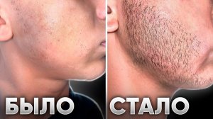 Мазал это средство и ОТРАСТИЛ БОРОДУ С НУЛЯ ЗА 3 МЕСЯЦА. Результат Mr.Volos