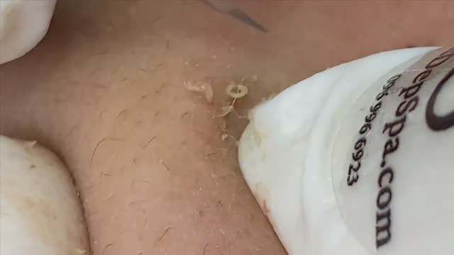 Лечение акне (прыщей) на коже смотреть онлайн