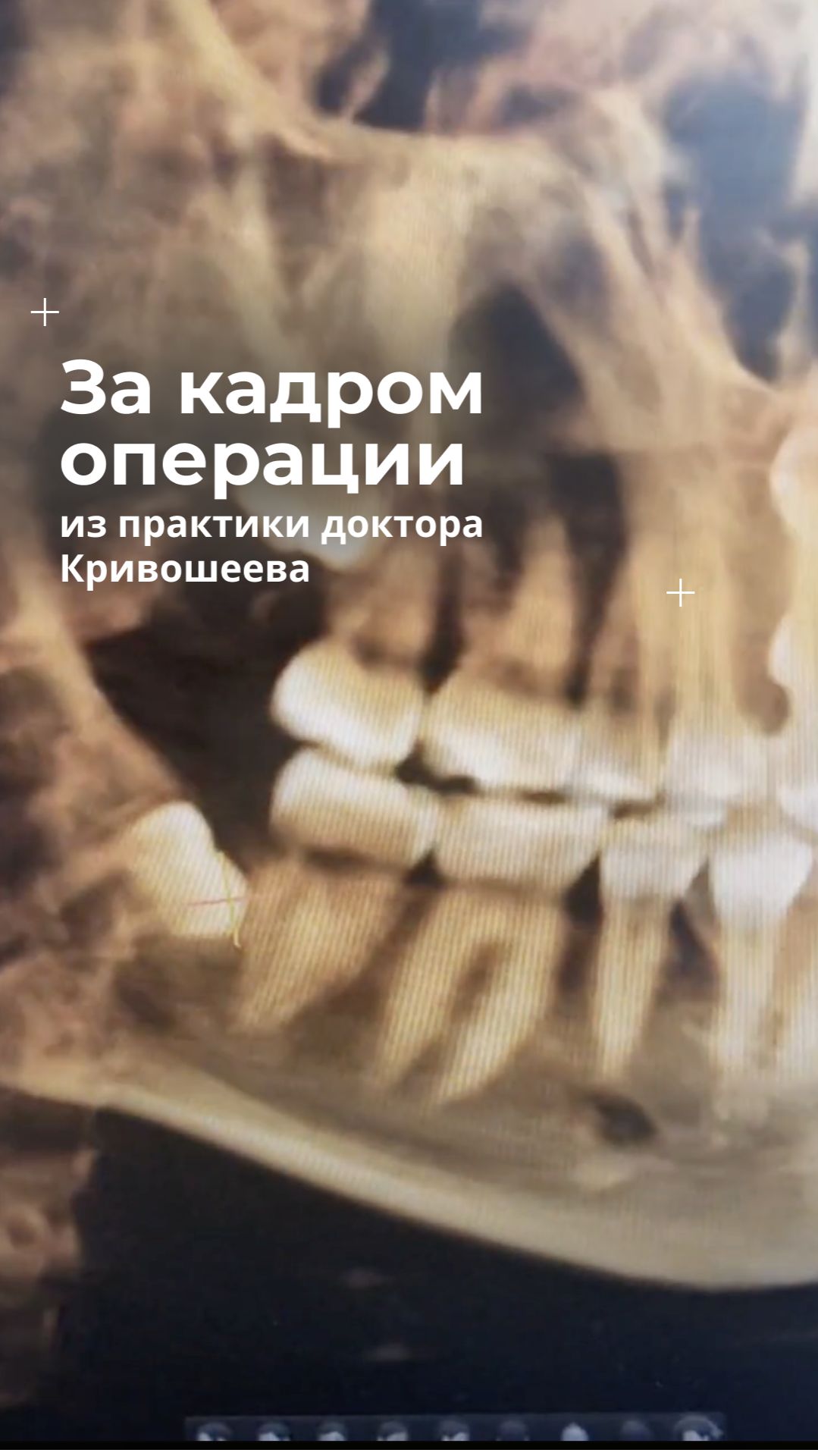 Удаление зачатка зуба мудрости: когда это проще и безопаснее #shots