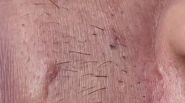 Лечение акне, Себумные нити (волокна) на коже