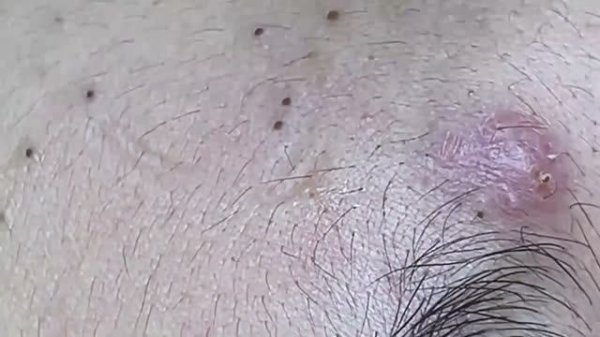 Asmr. Избавление от черных точек. 2173