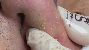 Полное очищение от черных точек. 100% очищение пор.