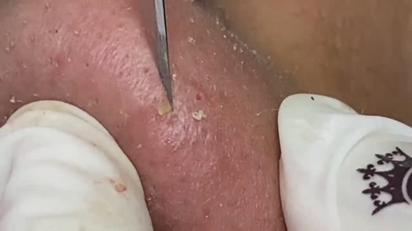 Fire! Битва с черными точками на носу: самое зрелищное удаление!