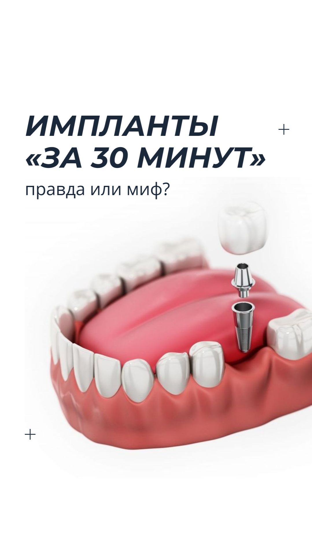 Импланты «за 30 минут» звучит привлекательно — но всегда ли это безопасно? #shots