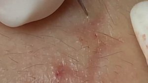 Выдавливание прыщей, угрей, черных точек и камедонов #43