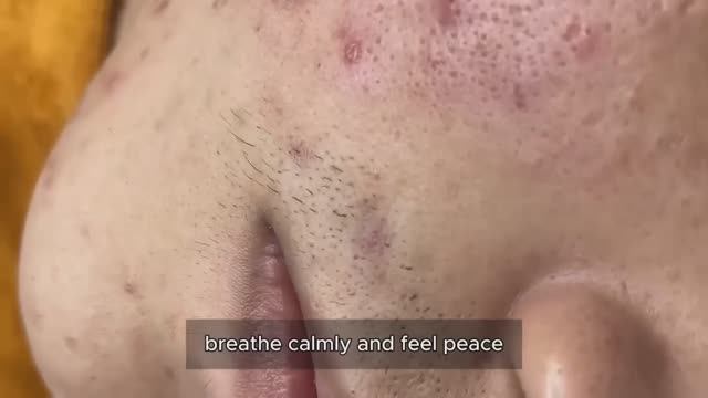 Asmr. Механическое очищение от прыщей и сальных пробок. 90394 смотреть онлайн