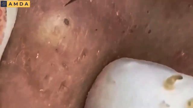 Asmr. Чистим лицо от угней и сальных пробок _ 2146 смотреть онлайн