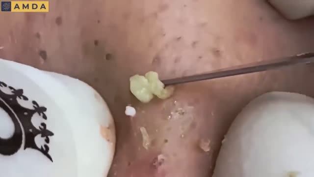 Asmr. Профессиональная чистка от черных точек и сальных пробок. 12142 смотреть онлайн