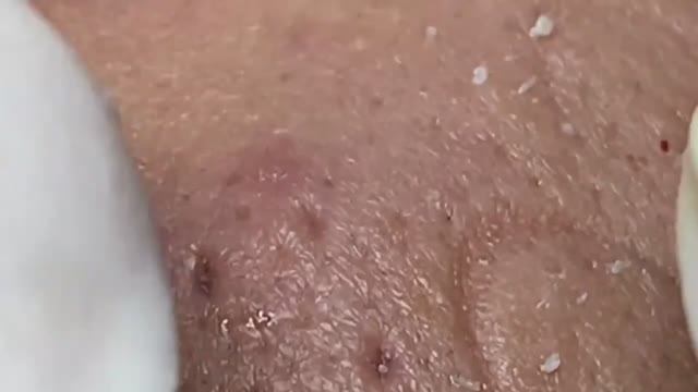 Профессиональное удаление комедонов: тонкая работа мастера. 2171 смотреть онлайн