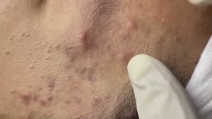 Asmr. Чистим лицо от черных точек. #122