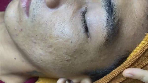 Гигантские комедоны для вашего отдыха