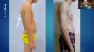 10 фактов о сутулости и гиперкифозе, из-за которых у вас нет стабильных результатов