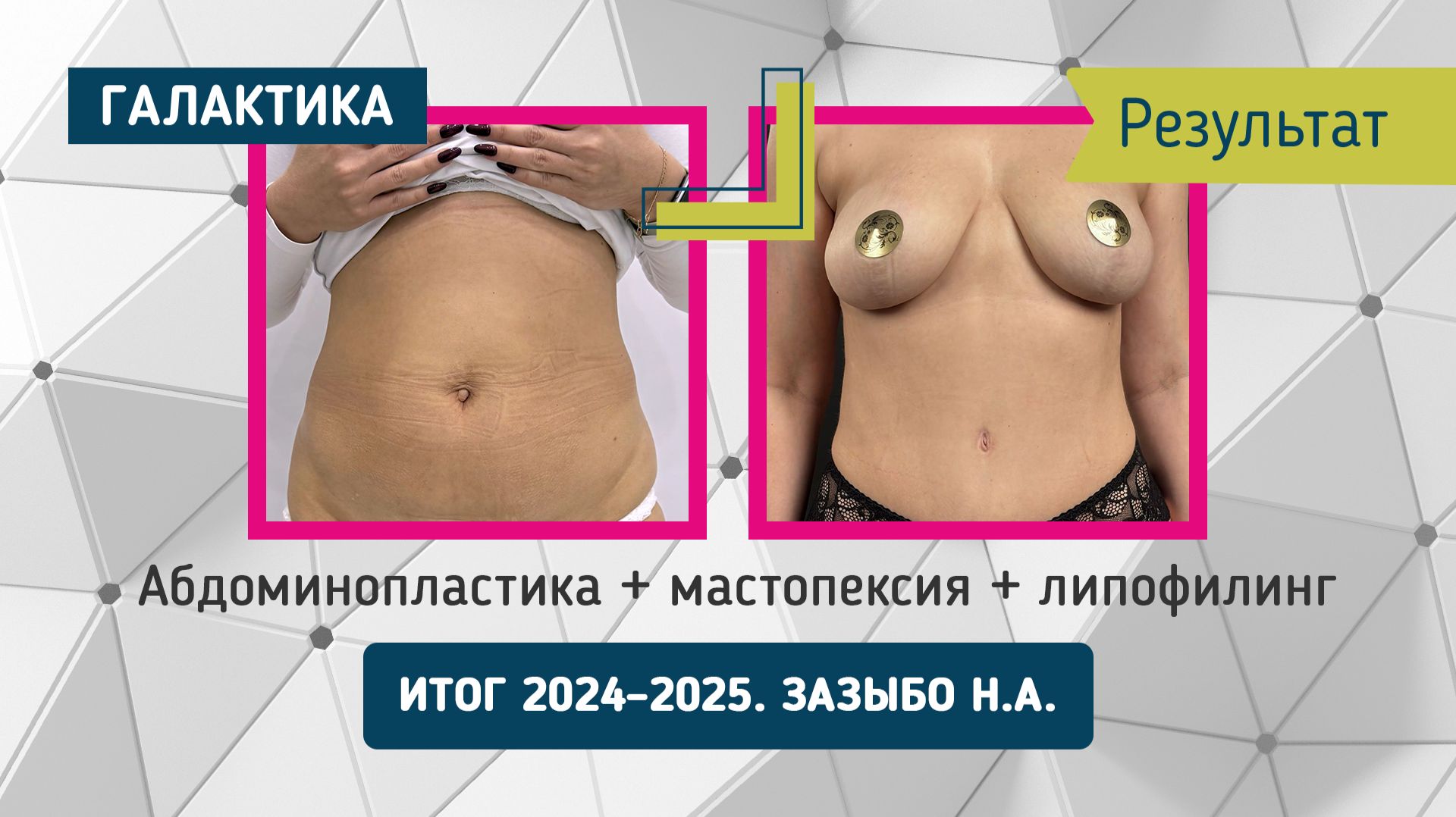 🔥 Абдоминопластика + мастопексия + липофилинг - результат от Николая Зазыбо смотреть онлайн