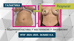 🔥 Абдоминопластика + мастопексия + липофилинг - результат от Николая Зазыбо